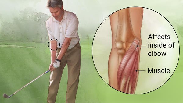 ارنج گلف بازان (Golfers elbow or medial epicondylitis)